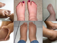 Це справді працює! Як позбутися набряків на ногах - поради лікаря