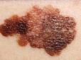 Вчені назвали ранні симптоми раку шкіри